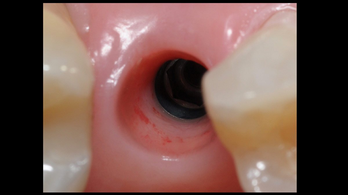 Immediate-implant-placement-with-GBR-1-stage