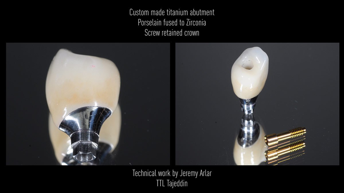 Immediate-implant-placement-with-GBR-1-stage