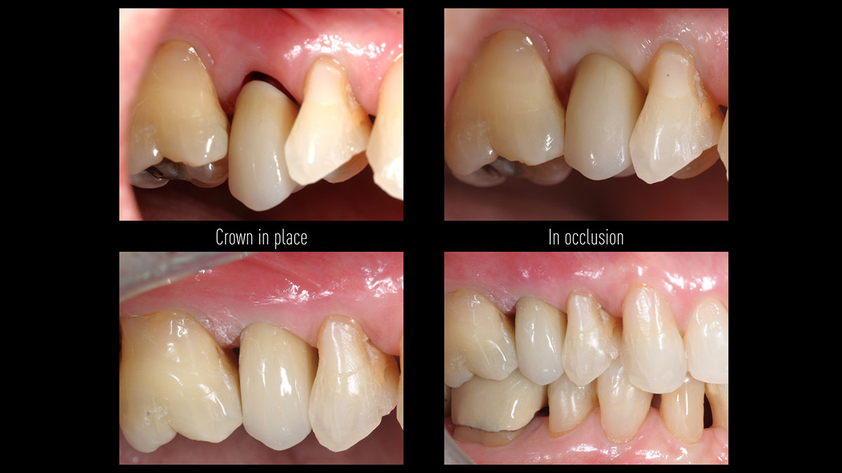 Immediate-implant-placement-with-GBR-1-stage