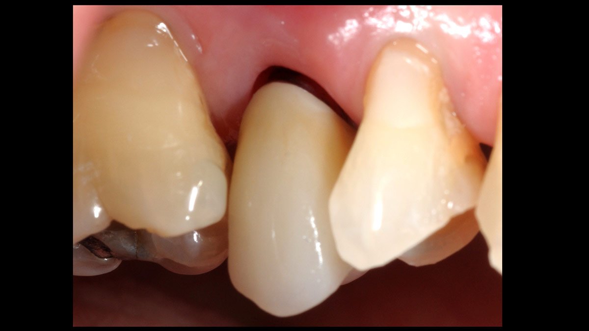 Immediate-implant-placement-with-GBR-1-stage