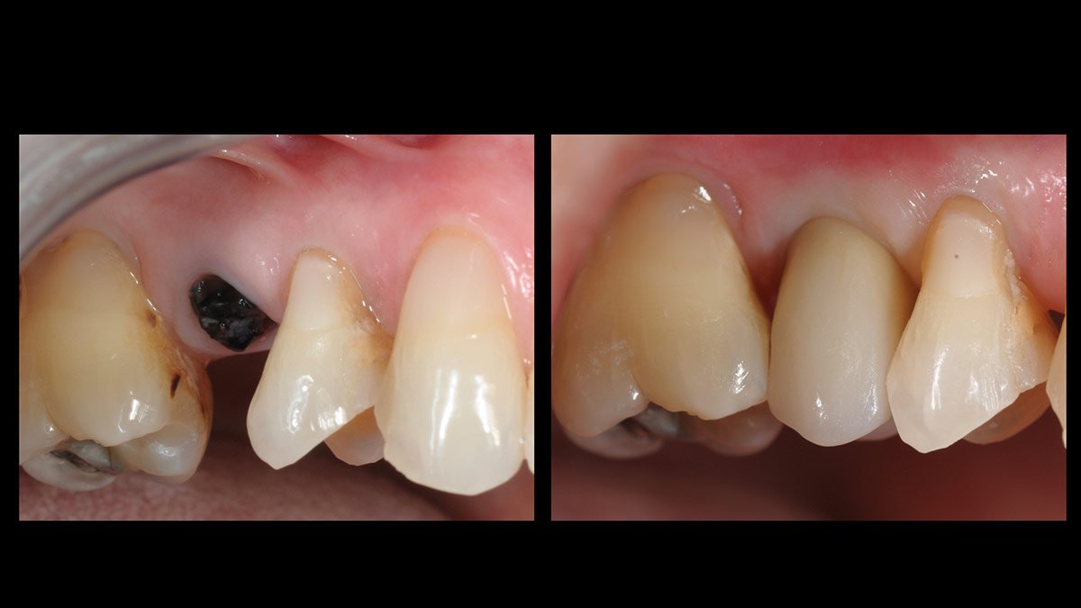 Immediate-implant-placement-with-GBR-1-stage