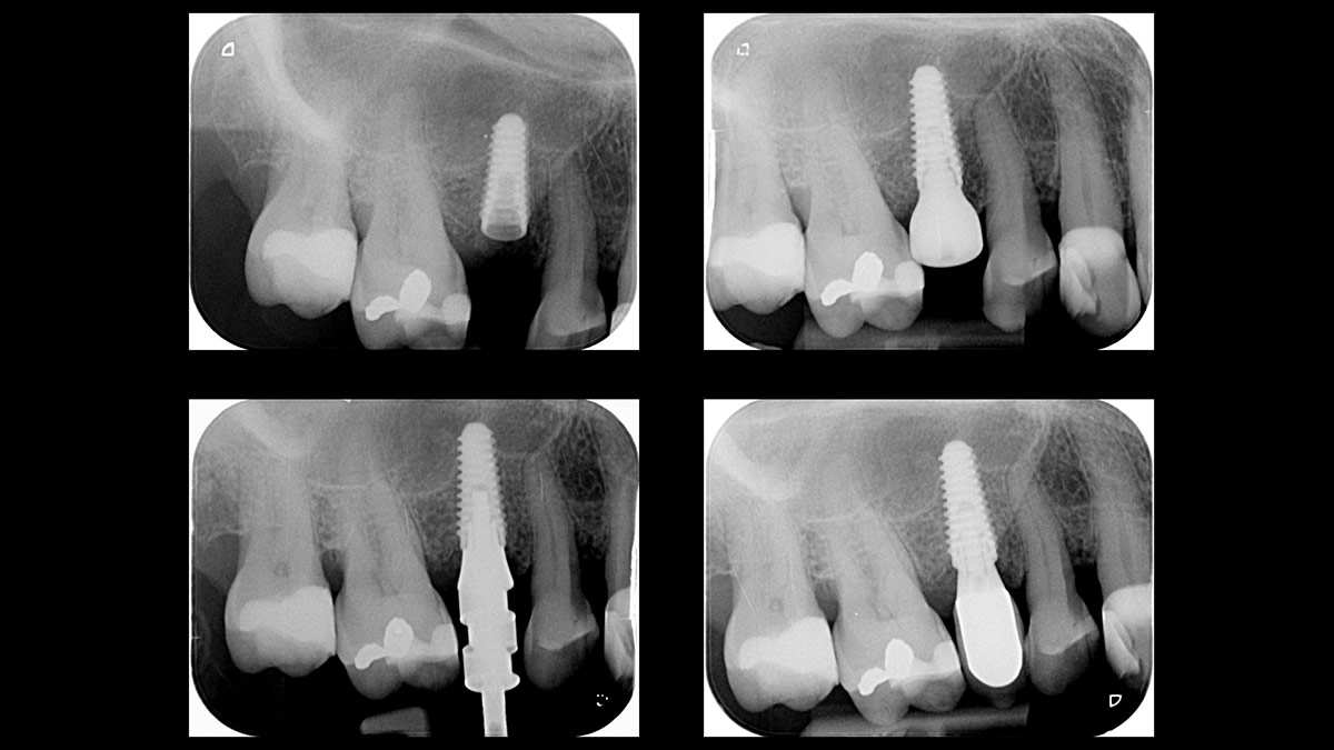 Immediate-implant-placement-with-GBR-1-stage