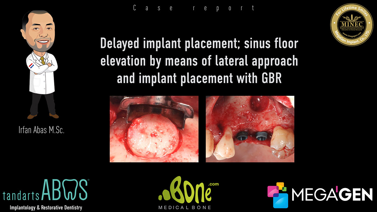Delayed-implant-placement