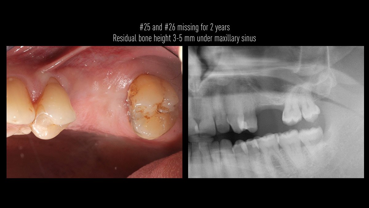 Delayed-implant-placement