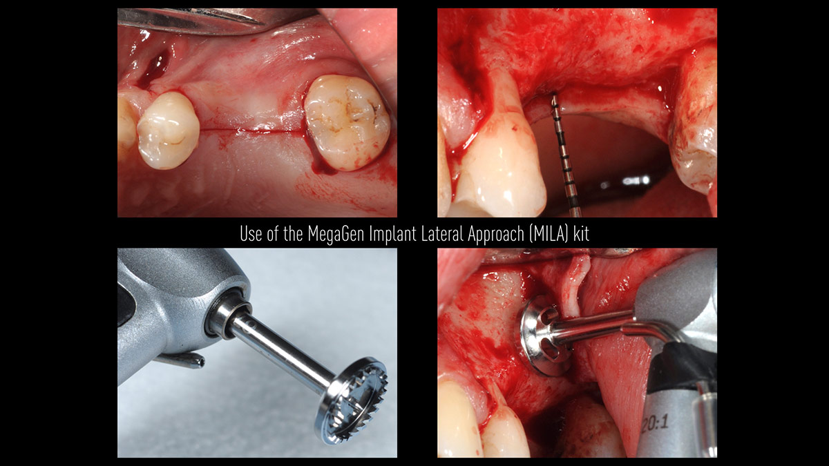 Delayed-implant-placement