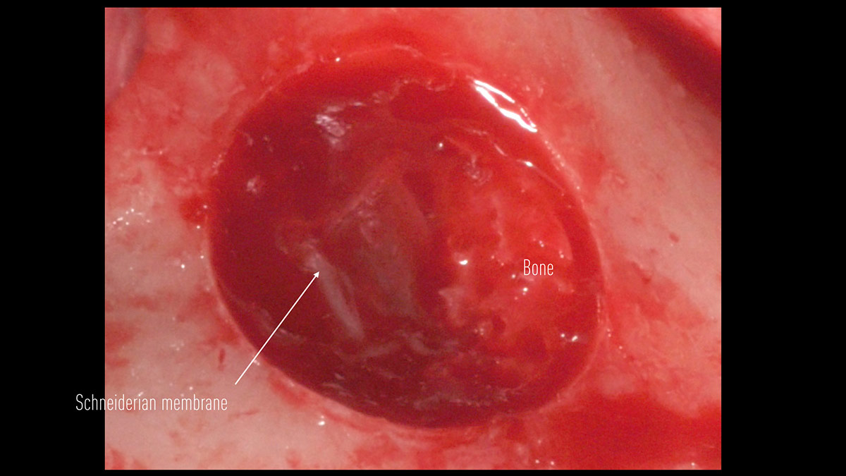 Delayed-implant-placement