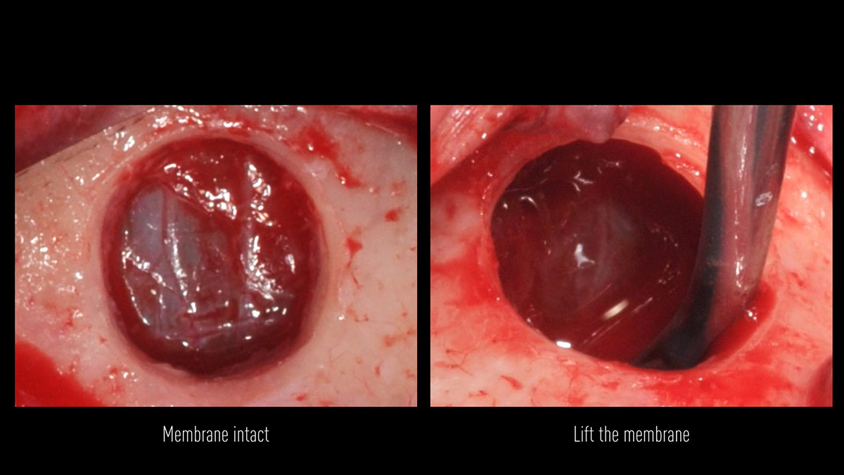 Delayed-implant-placement