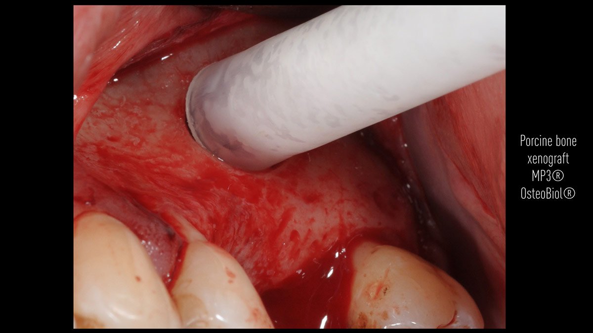 Delayed-implant-placement