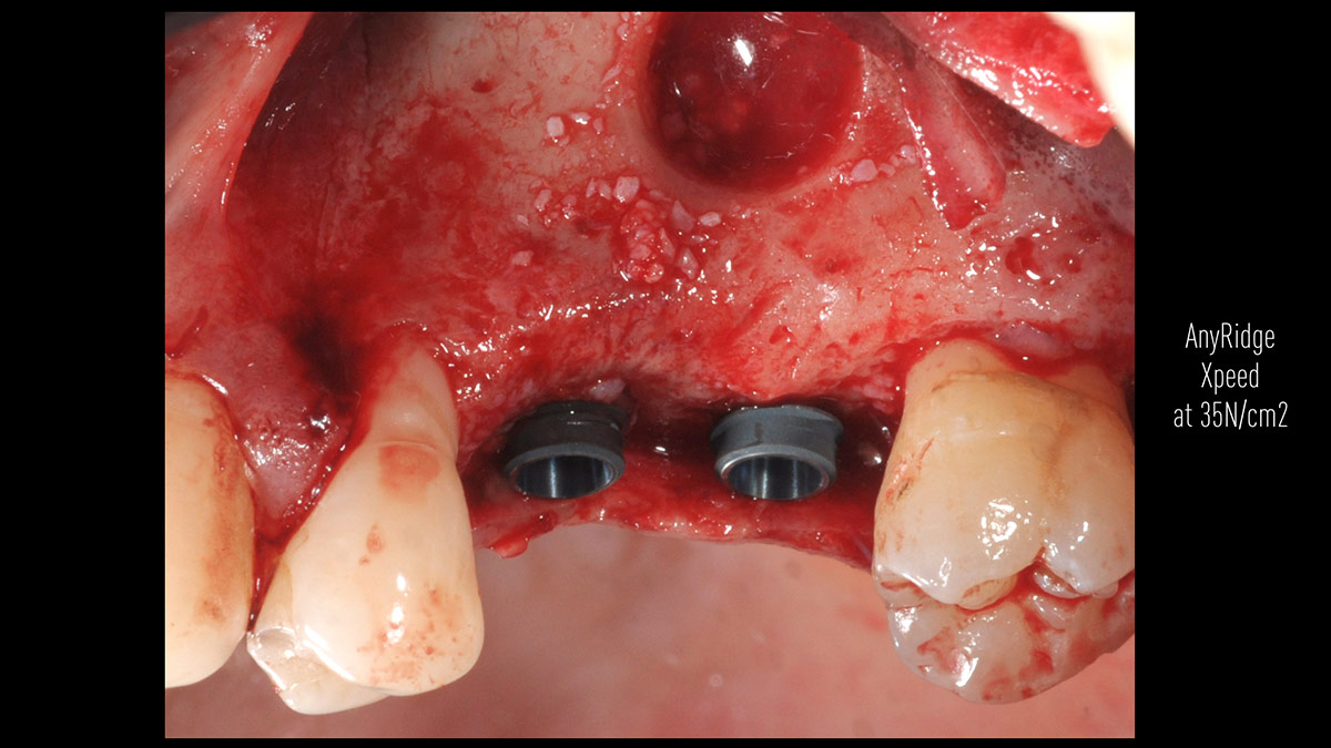 Delayed-implant-placement
