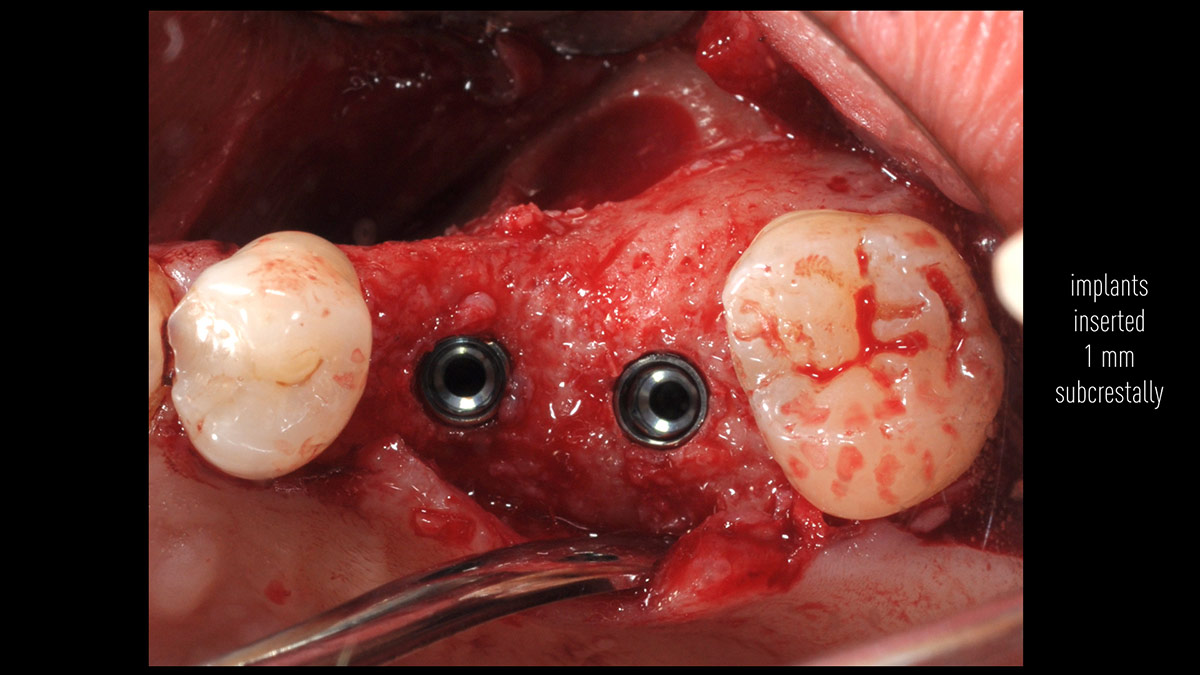 Delayed-implant-placement