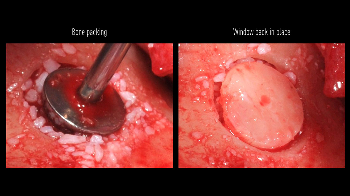Delayed-implant-placement