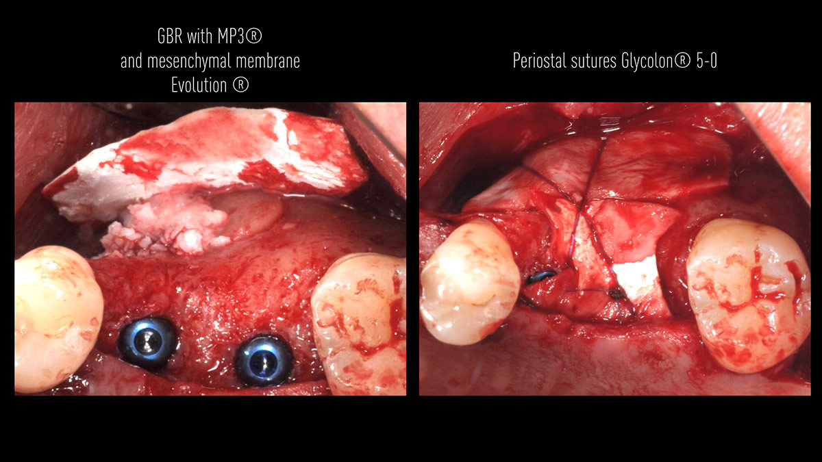 Delayed-implant-placement