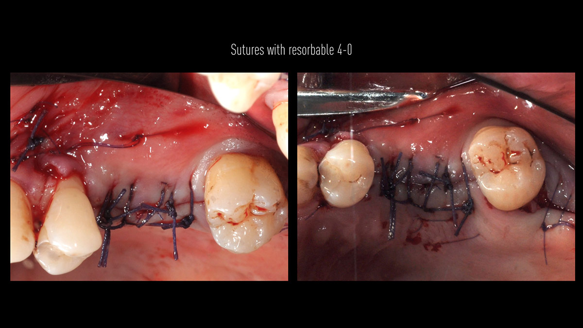 Delayed-implant-placement