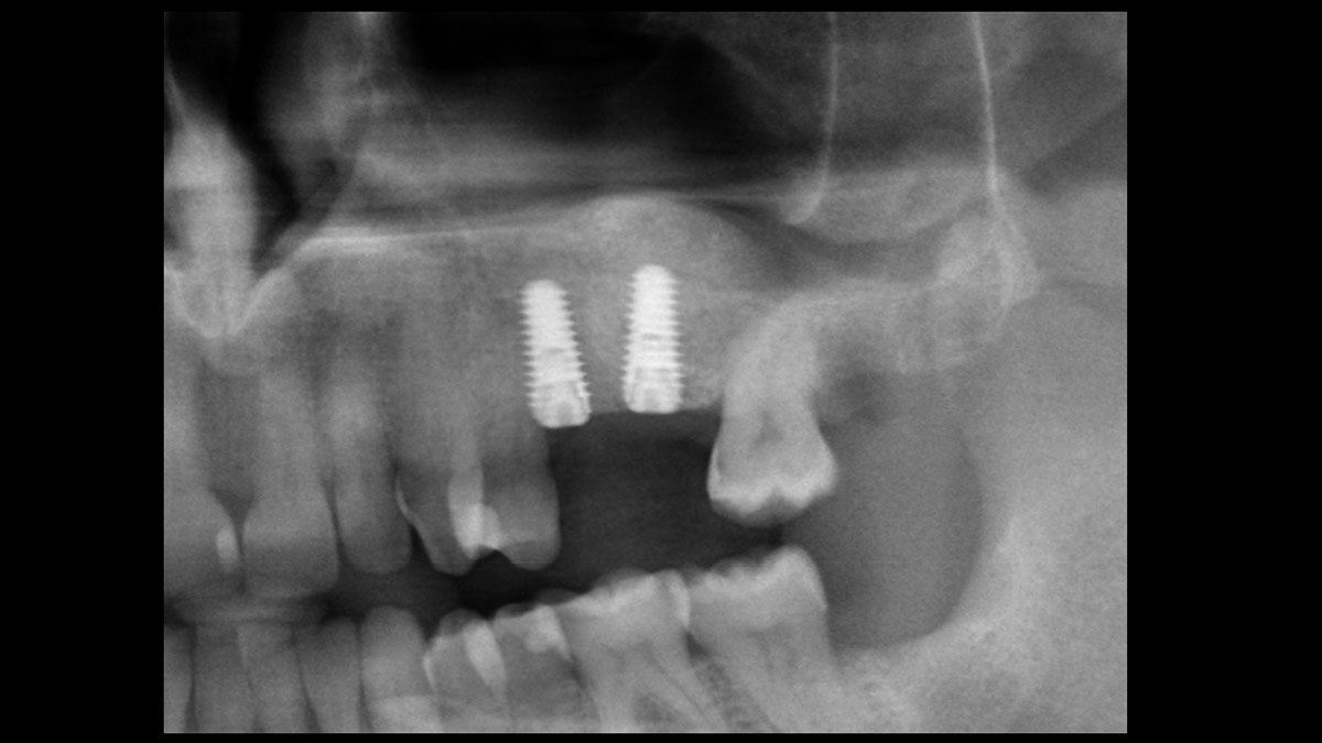 Delayed-implant-placement